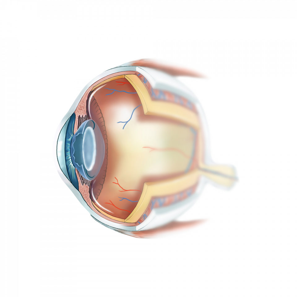 cof cataracte implant